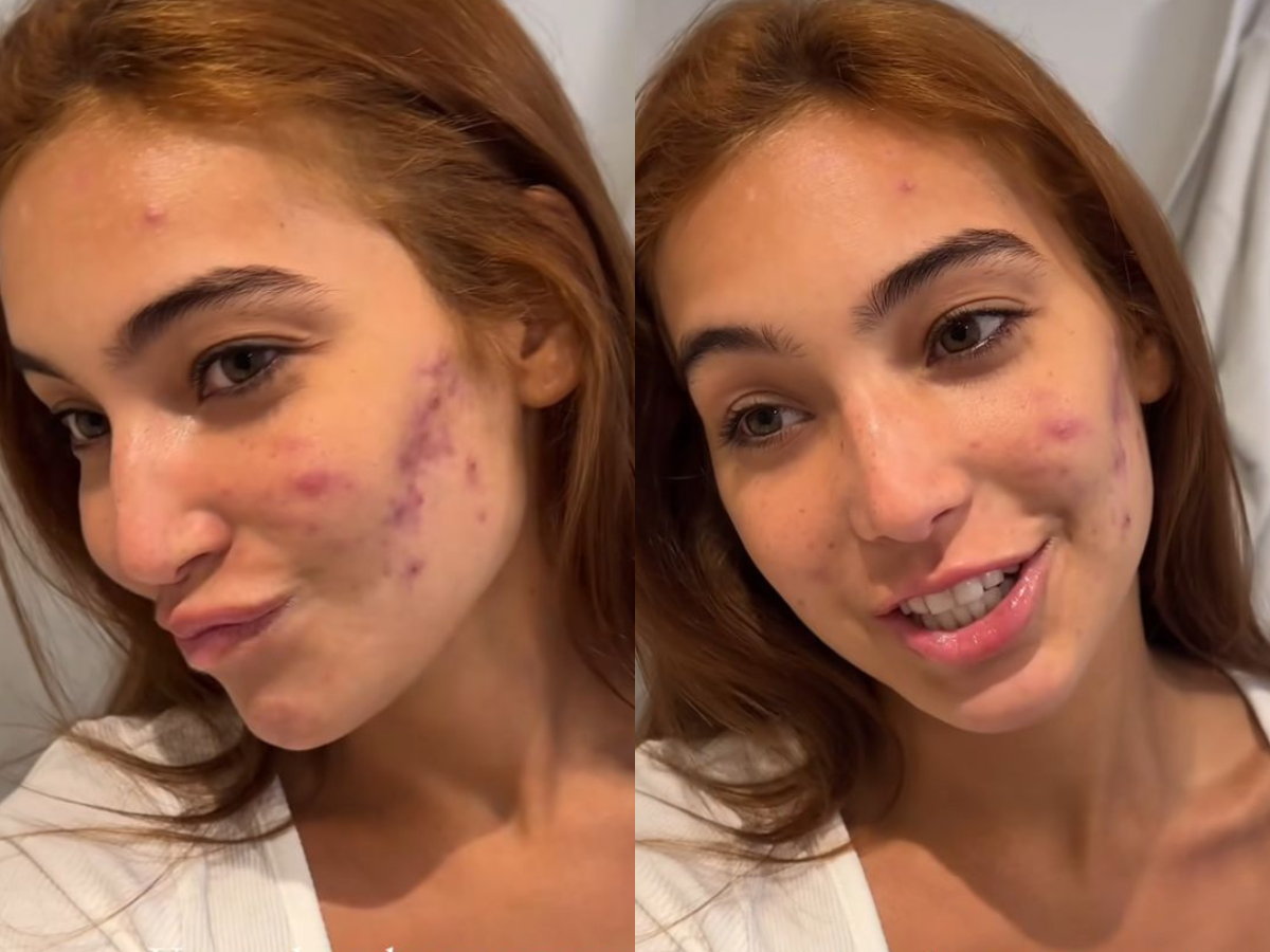 Vanessa Lopes fala sobre tratamento para acne e se acostuma com as ofensas 💬✨